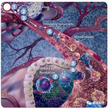 癌癥轉(zhuǎn)移機制