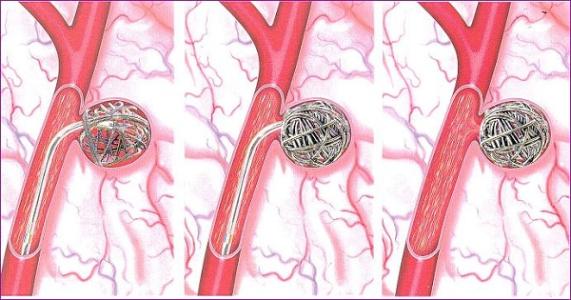 可拉伸的無線傳感器可以監測腦動脈瘤的愈合