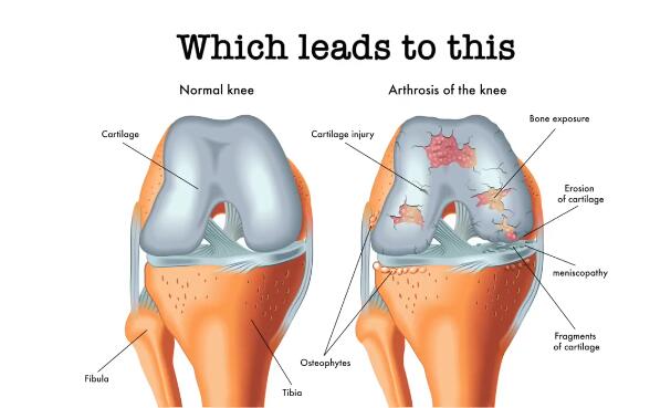微流控“軟骨”芯片(Knee On Chip)用于關(guān)節(jié)炎研究 微流控“軟骨”芯片(Knee On Chip)用于關(guān)節(jié)炎研究